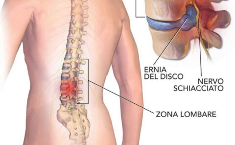 Quale Fisioterapia Per L Ernia Del Disco Fisioterapia Latina